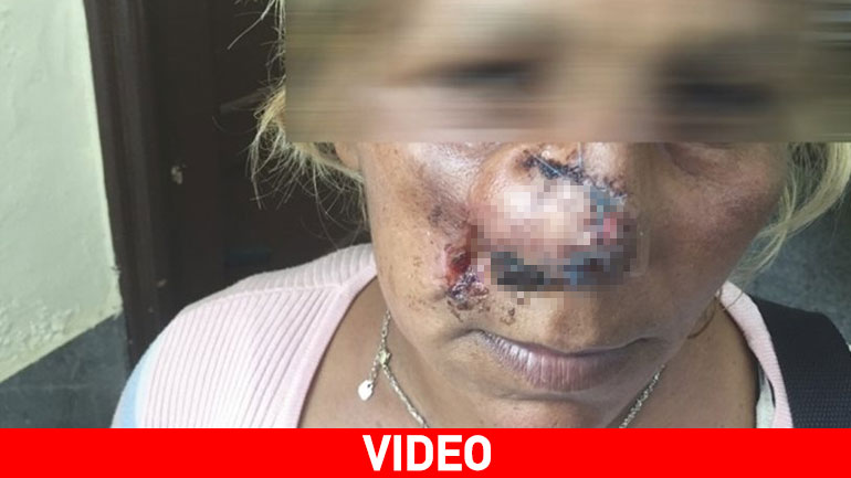 Ρόδος: Της επιτέθηκαν, την ξυλοκόπησαν και της… έκοψαν τη μύτη