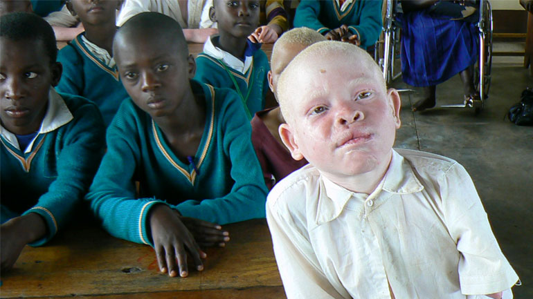 Τανζανία: Έκοψαν το χέρι εξάχρονου αλμπίνου με ματσέτα