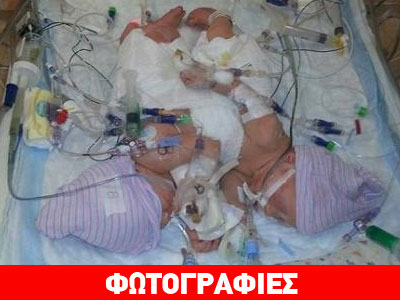 Σιαμαία δίδυμα γεννήθηκαν στη Φλόριντα