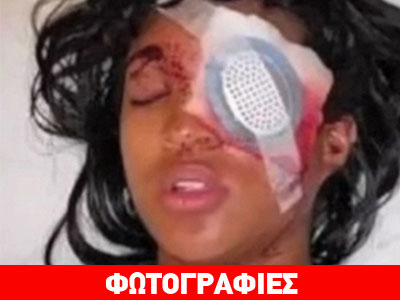 Φέργκιουσον: Έγκυος έχασε το μάτι της από πυρά αστυνομικού