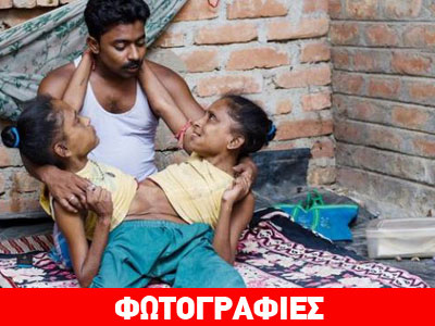 Σιαμαίες μοιράζονται τον ίδιο… αγαπημένο!