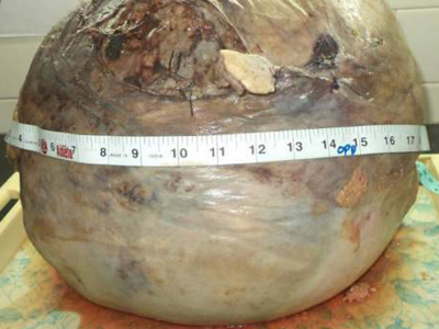 Ινδία: Αφαίρεσαν όγκο 13 κιλών, μεγέθους καρπουζιού