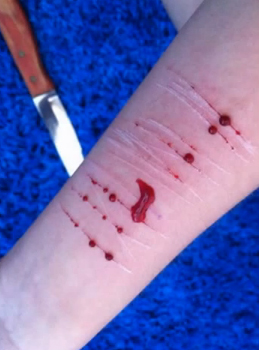 Μία από τις πολλές απόπειρες αυτοκτονίας που είχε κάνει η Αμάντα