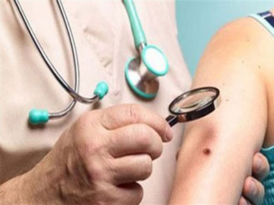 Σπίλοι και Μελανώματα: Όλα όσα πρέπει να γνωρίζετε