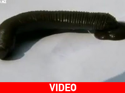 Βδέλλα αφαιρέθηκε από τον λάρυγγα 16χρονου