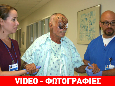 Με νέο πρόσωπο μετά από επίθεση κανιβάλου