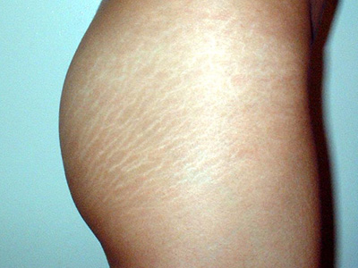 Εξαφανίστε τις ραγάδες