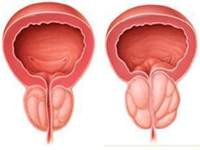 Η κατανόηση της ανάπτυξης του προστάτη αδένα  ανοίγει το δρόμο για νέες θεραπείες
