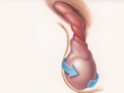 Πως τίθεται η διάγνωση της συστροφής όρχεως; Μέρος 2ο