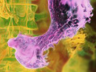 Τεστ αναπνοής διαγιγνώσκει τον καρκίνο του στομάχου; Τεστ αναπνοής διαγιγνώσκει τον καρκίνο του στομάχου;