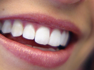 Λεύκανση δοντιών – Μύθοι και πραγματικότητα