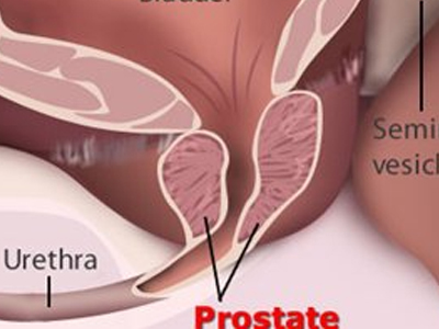 Πώς να προστατέψετε τον προστάτη