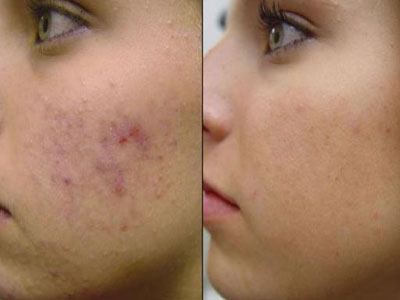 Ακμή μετά τα 30