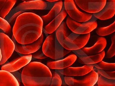 Η αναιμία είναι γένους θηλυκού