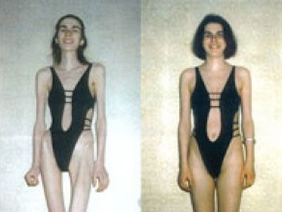 Επιδημία η βουλιμία στην εφηβεία