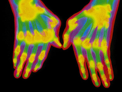 Γυμναστική εναντίον της αρθρίτιδας