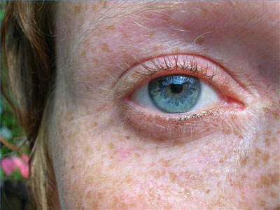 Λέιζερ κατά των πανάδων