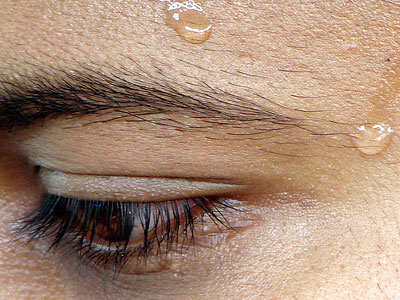 Τέλος στον ιδρώτα με Botox