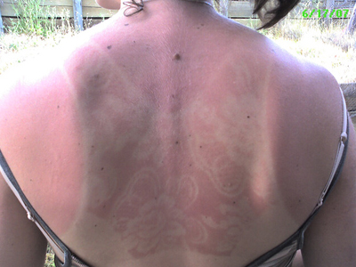 Δωρεάν εξετάσεις για τον καρκίνο του δέρματος