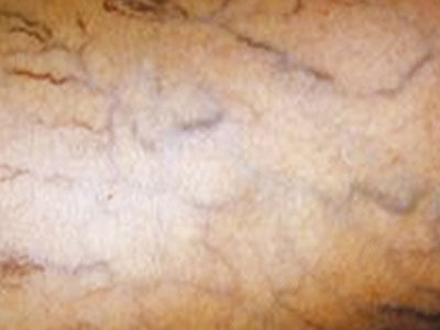 Πως θα αποφύγετε την εμφάνιση κιρσών