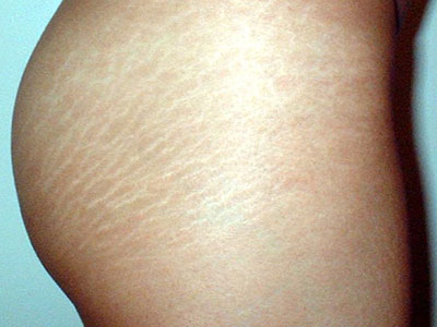 Πώς να αποφύγετε τις ραγάδες