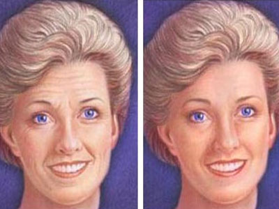 Σβήστε τις ρυτίδες με λίπος