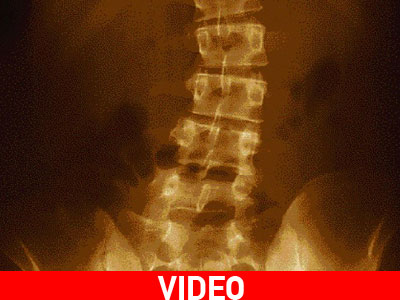 Pilates για την σκολίωση