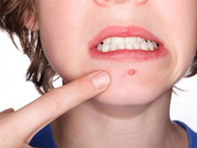 Σπυράκι στο πρόσωπο την τελευταία στιγμή