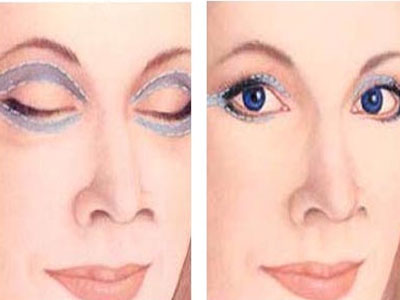 Τα «ναι» και τα «όχι» της βλεφαροπλαστικής