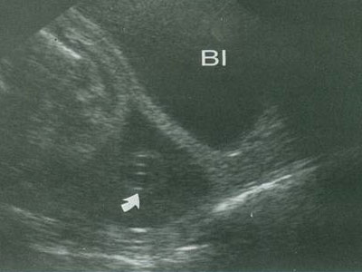 Έχω ενδομητρίωση. Θεραπεύεται;