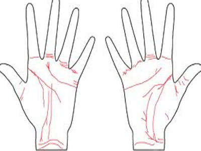 Διαβάστε στο …χέρι σας αν έχετε αναιμία