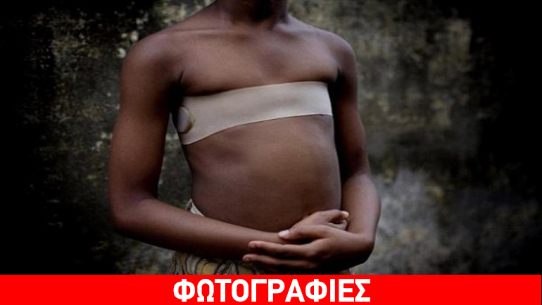 Αφρική: Εκατομμύρια γυναίκες αυτοακρωτηριάζονται ώστε να δείχνουν μη θηλυπρεπείς και να αποφεύγουν τους βιασμούς…