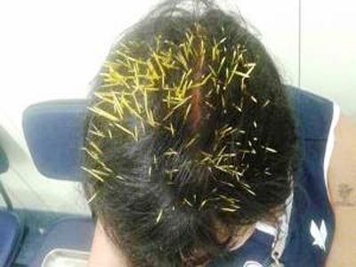 Σκαντζόχοιρος προσγειώθηκε στο κεφάλι γυναίκας και την έστειλε στο… χειρουργείο!