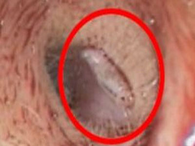 Φρίκη: Σκουλήκι κατέλαβε το αυτί γυναίκας!