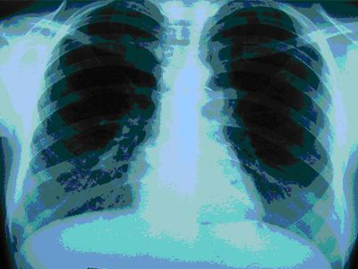 Οι ακτινογραφίες και τομογραφίες αυξάνουν τον κίνδυνο καρκίνου σε παιδιά