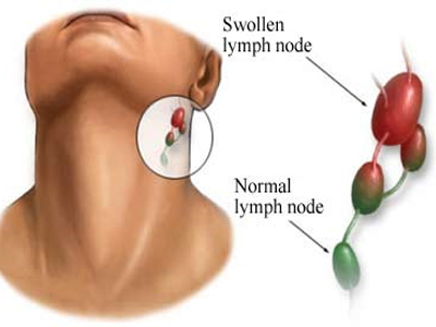 Λοιμώδης μονοπυρήνωση: Όλα όσα πρέπει να ξέρετε