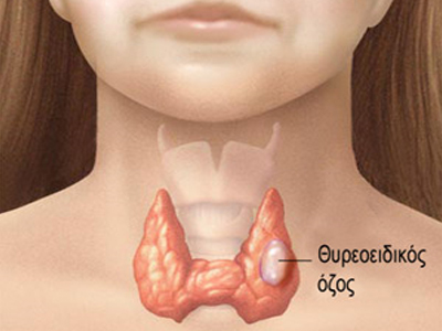 Αύξηση της αυτοάνοσης θυρεοειδίτιδας στη χώρα μας