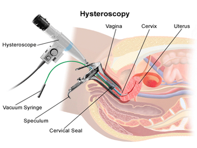 Υστεροσκόπηση: Μια πολύτιμη εξέταση