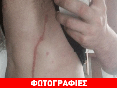 Eπέστρεψε από διακοπές με μια αράχνη μέσα στο σώμα του