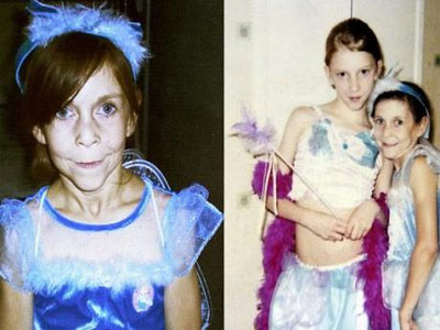 Δεκαεξάχρονη «εγκλωβισμένη» σε σώμα 60χρονης