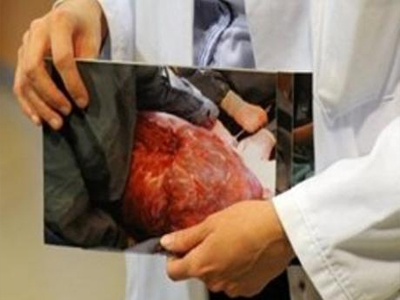 Της αφαίρεσαν όγκο βάρους 28 κιλών!