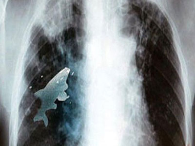 Ψάρι «κολυμπούσε» στον πνεύμονα έφηβου