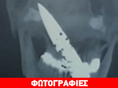 Κίνα: Ζούσε για 4 χρόνια με ένα μαχαίρι στο κεφάλι