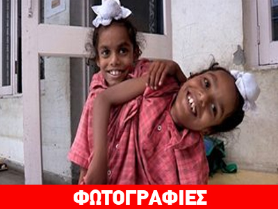 Σιαμαία έγιναν 9 ετών διαψεύδοντας την επιστήμη!!!