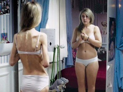 Νευρική ανορεξία, νευρική βουλιμία και οι επιπτώσεις τους στα δόντια