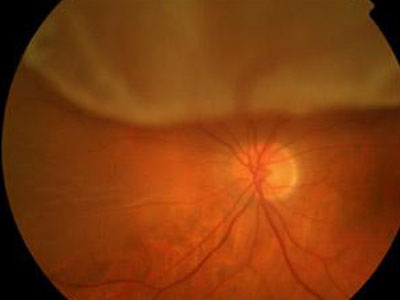 Αποκόλληση υαλοειδούς: Ο αθόρυβος επισκέπτης