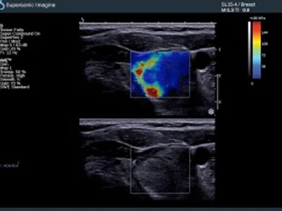 Νέα ακριβέστερη τεχνική ShearWave ελαστογραφίας