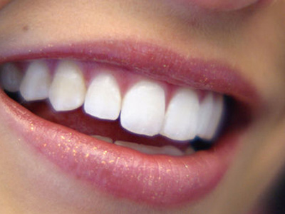 Λεύκανση δοντιών – Μύθοι και πραγματικότητα