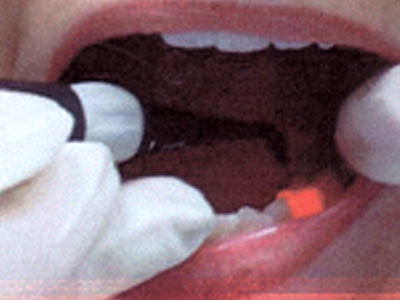 Νέο σύστημα ανίχνευσης τερηδόνας