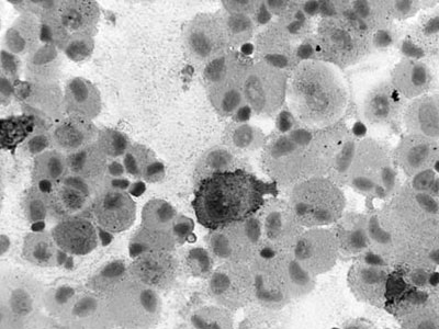 Ιστιοκύττωση Langerhan – Μία σπάνια ασθένεια και στην Ελλάδα